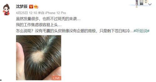 哪些明星斑秃,斑秃背后的明星故事
